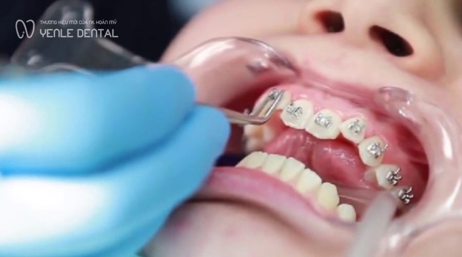 40 tuổi có niềng răng được không